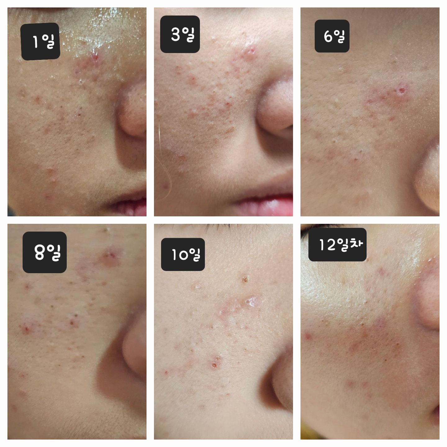 Trouble Sebum Softening LHA Pad (10 Pads)